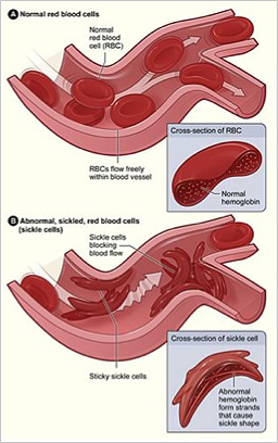 siclecelldiagram